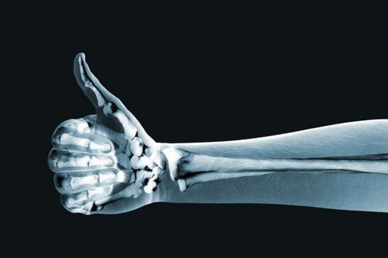 Röntgenaufnahmen können bei der Diagnose von Schmerzen in den Fingergelenken hilfreich sein