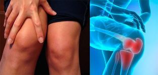 Beschwerden und Schwellungen im Kniebereich sind die ersten Symptome einer Arthrose