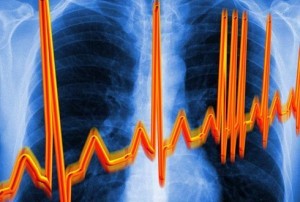 Veränderungen und Störungen im Herzrhythmus sind ein Zeichen für eine zervikale Osteochondrose